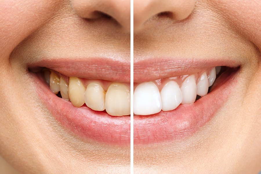 Teeth Whitening at Home: Tips and Techniques You Need to Know